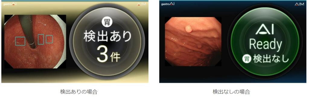 内視鏡画像診断支援システム「ガストロＡＩ―モデルＧ２」。病変が疑われる領域を検出する